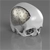 Metal 3D printed cranial plate